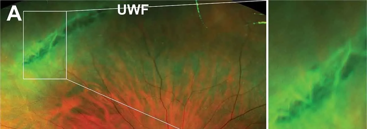 Imagem ampla da periferia da retina com uma área esbranquiçada de bordas irregulares, ao lado de uma ampliação dessa região.