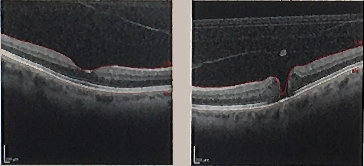 Dois cortes de tomografia de coerência óptica da retina mostrando um buraco macular como uma abertura na região central.