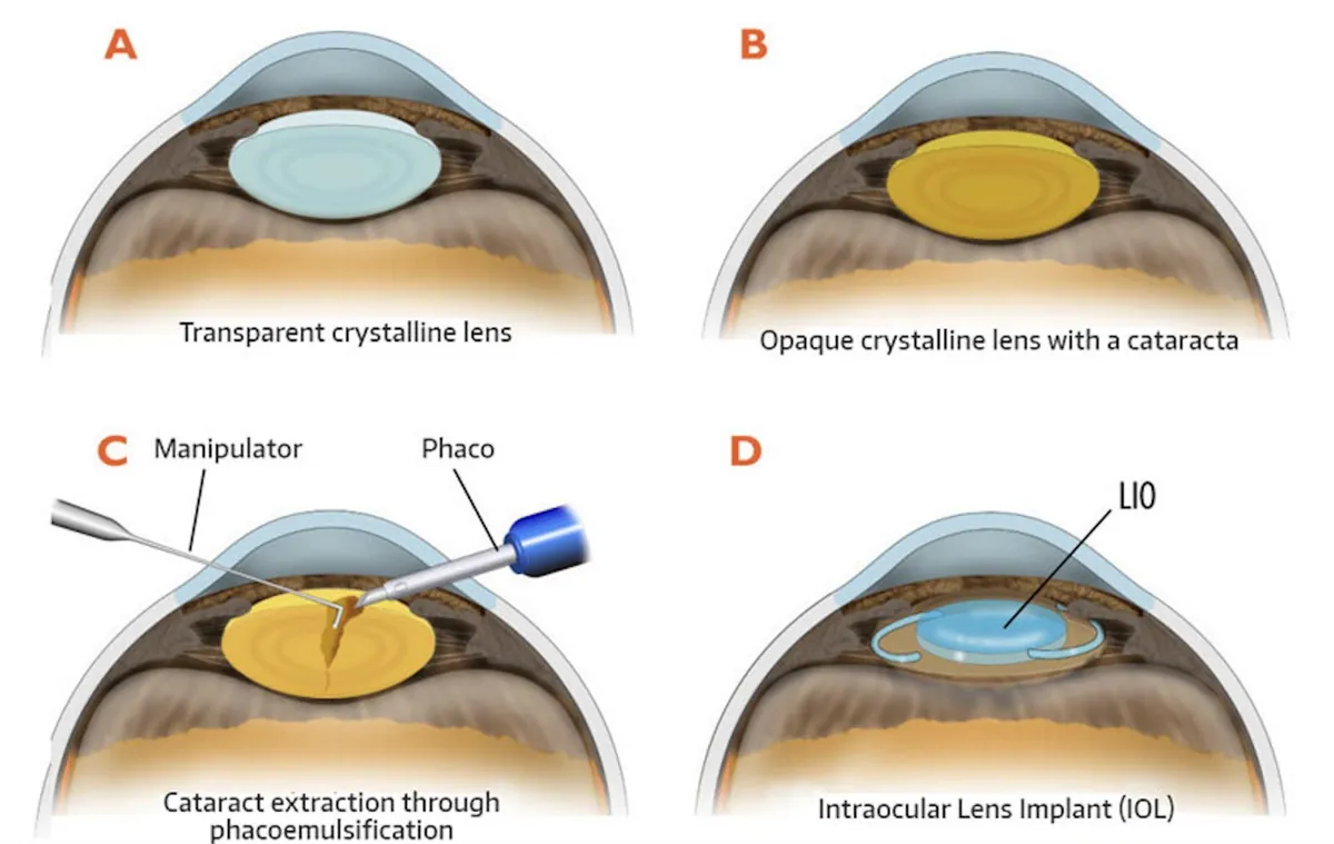 Diagrama em quatro quadros: cristalino transparente, cristalino opaco com catarata, remoção por facoemulsificação e lente intraocular implantada.