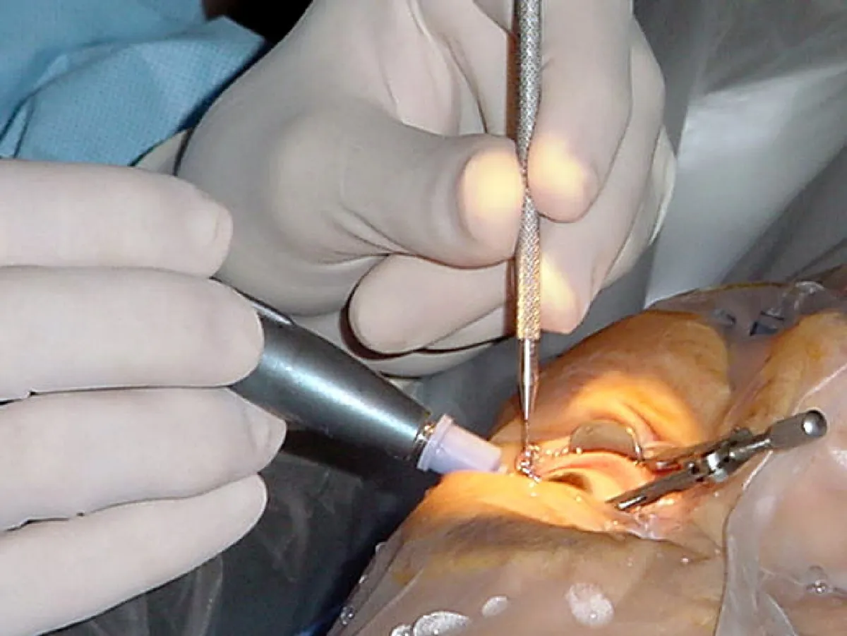 Mãos com luvas segurando instrumentos cirúrgicos junto ao olho de uma paciente durante o implante de uma lente intraocular.