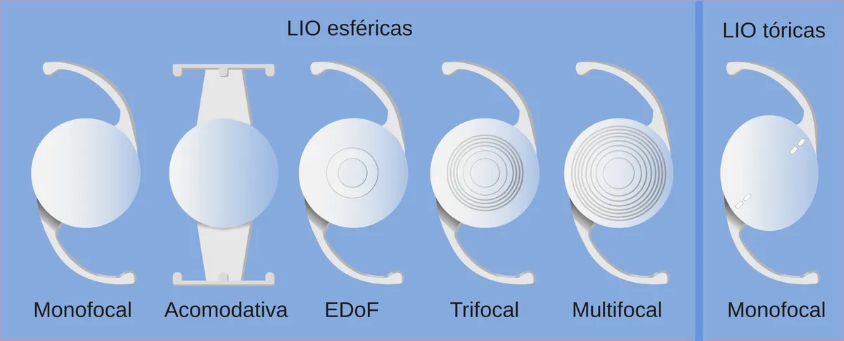Esquema de lentes intraoculares: monofocal, acomodativa, EDoF, trifocal e multifocal (esféricas) e monofocal tórica, com rótulos em espanhol.