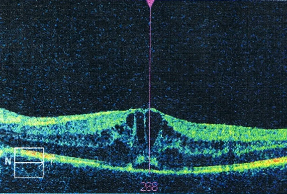Corte de tomografia de coerência óptica (OCT) da mácula, com pequenas cavidades escuras no centro, típicas de um edema macular.