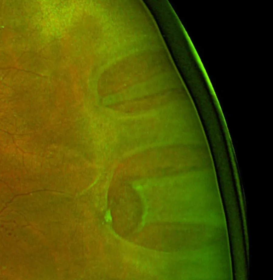Imagem de grande angular da retina em tons de verde e laranja, com uma área elevada e cheia de dobras.