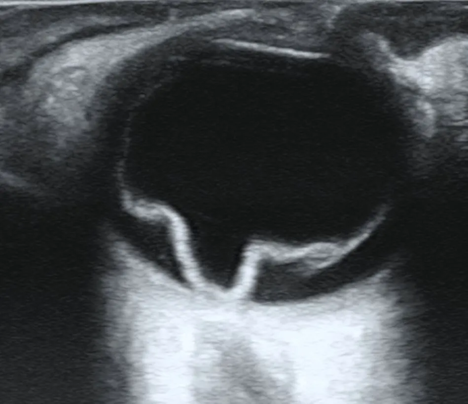 Imagem de ultrassom do olho com uma faixa clara em forma de V dentro de uma área escura, representando a retina descolada.