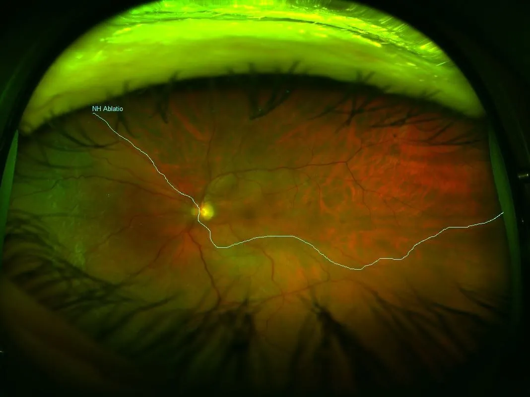 Imagem de grande angular do fundo do olho, com uma linha clara desenhada sobre a retina e um pequeno rótulo em azul.