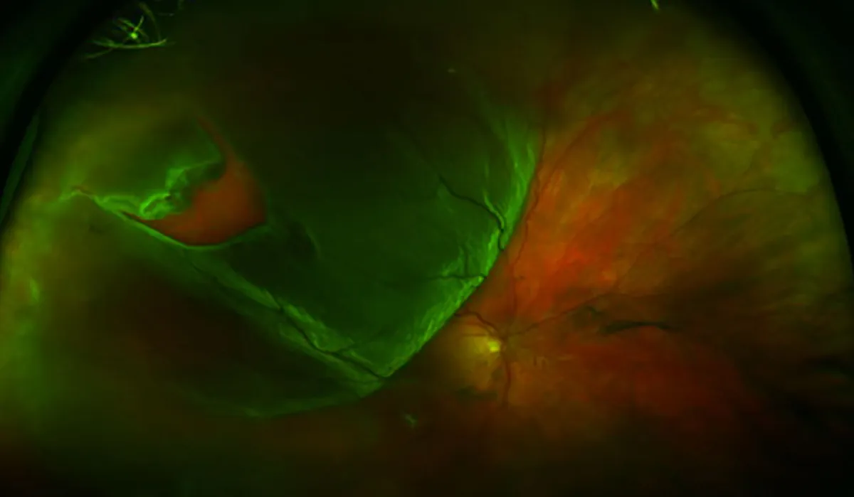 Imagem de grande angular da retina em tons de verde e vermelho, com uma área elevada e escura de um dos lados.