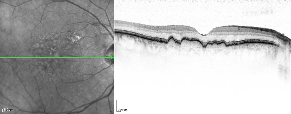 À esquerda, foto em tons de cinza da retina com uma linha verde indicando o corte; à direita, imagem de OCT com pequenas elevações sob a retina.