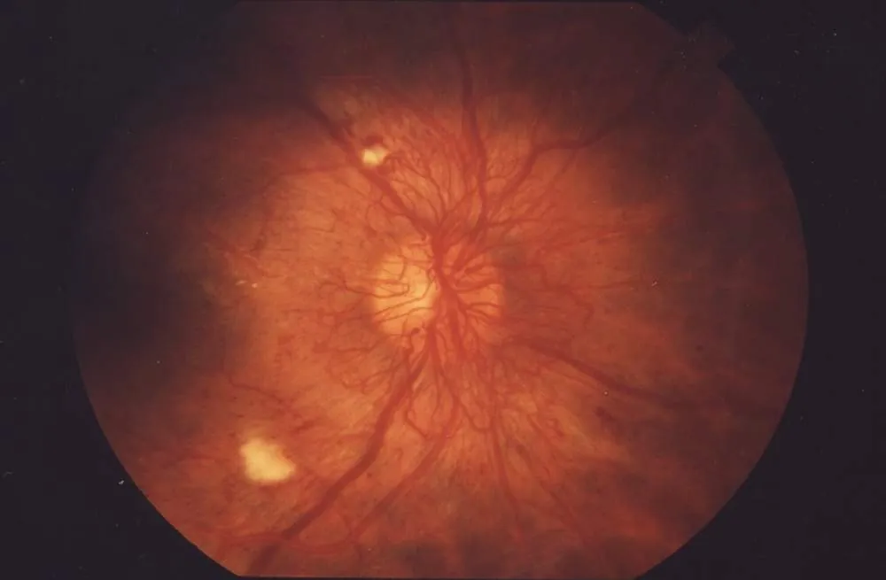 Fotografia do fundo do olho com retinopatia diabética proliferativa: retina com manchas claras e vasos alterados ao redor do disco óptico.