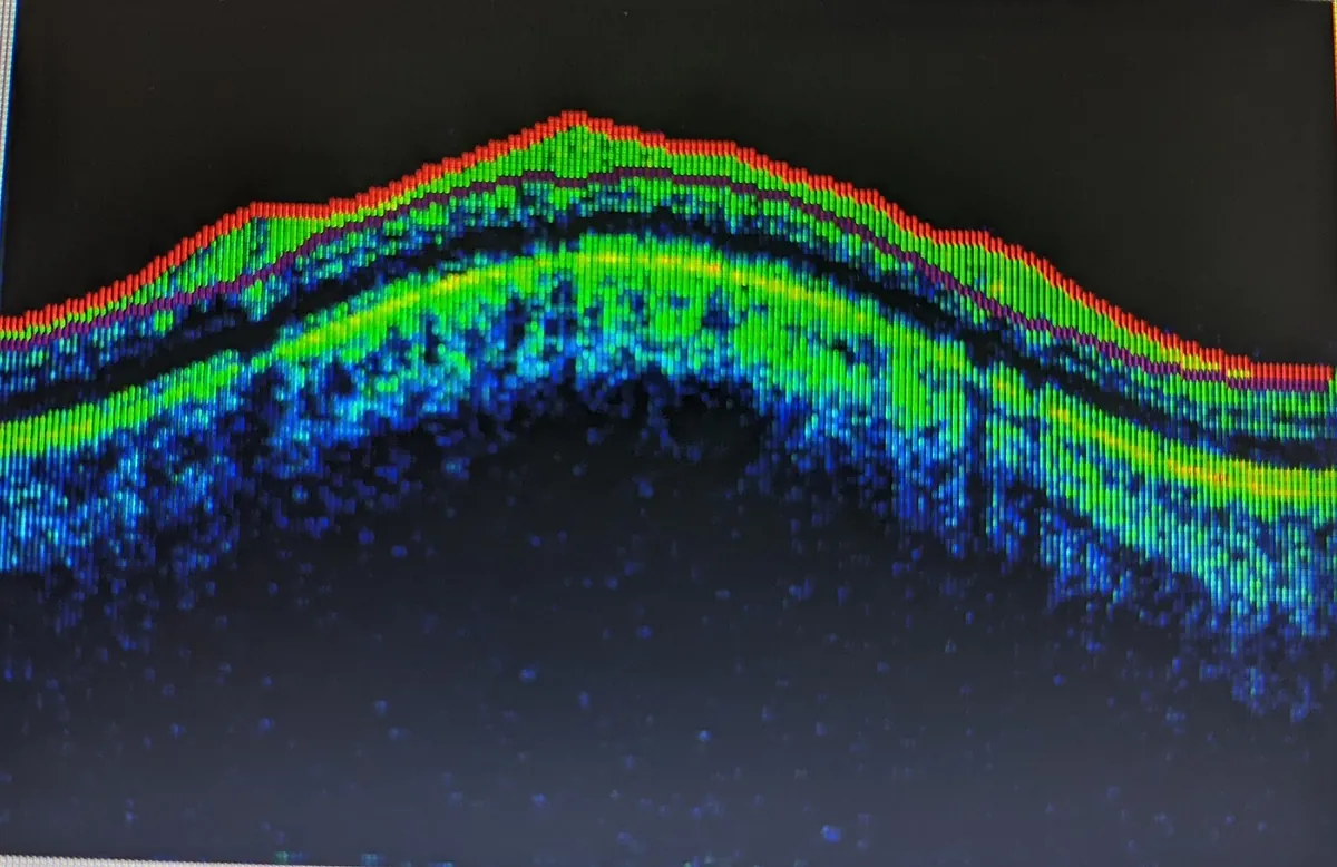 Corte de tomografia de coerência óptica (OCT) da retina, em cores, mostrando as camadas da retina em uma curva elevada.