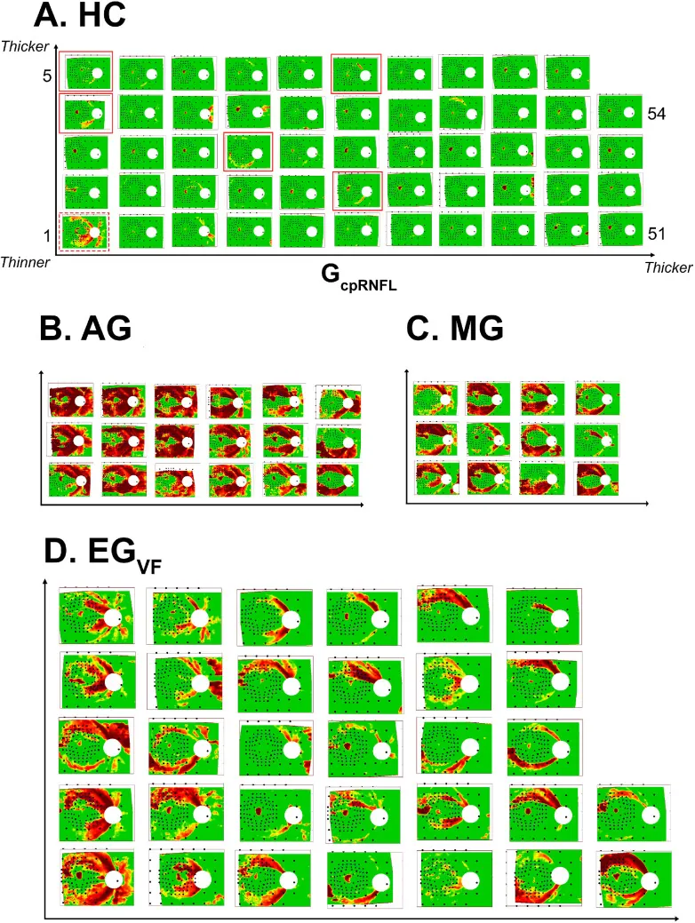 Mapas de probabilidade da camada de fibras nervosas da retina obtidos por OCT, organizados em quatro painéis: olhos de controles saudáveis (A) e olhos com glaucoma avançado (B), moderado (C) e precoce (D).