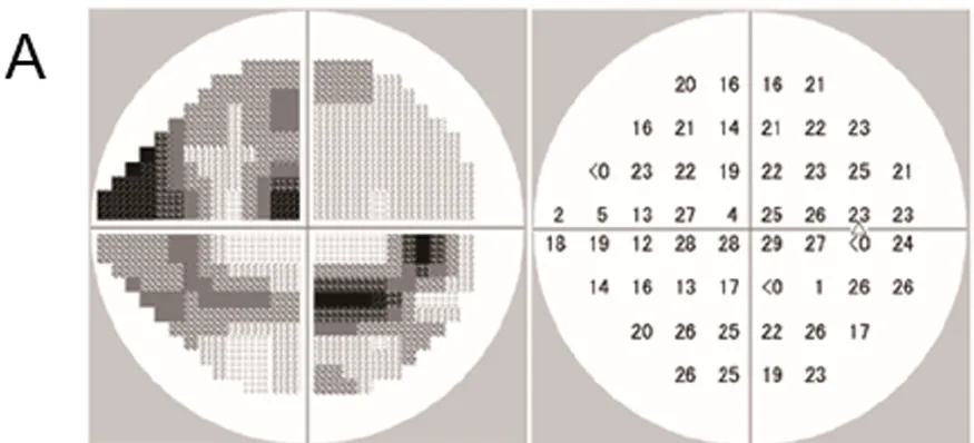 Duas colunas de resultados de exame de campo visual de um olho com glaucoma, com defeitos arqueados superior e inferior e escotoma paracentral superior.