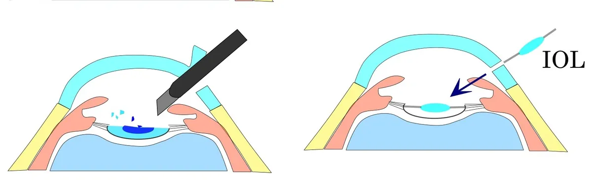 Dois desenhos do olho em corte: à esquerda, um instrumento retira o cristalino opaco; à direita, a lente intraocular (IOL) é colocada no lugar.