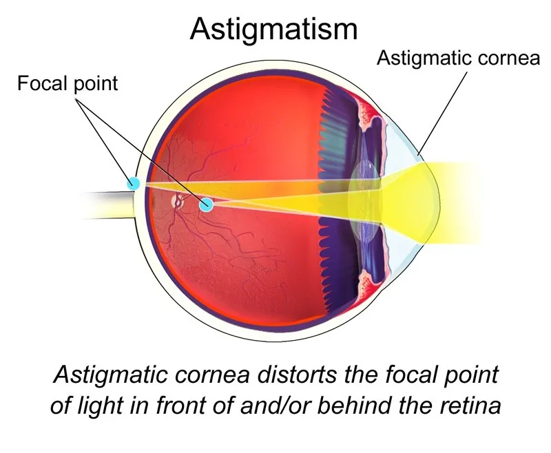 Esquema de um olho em corte, com a luz entrando por uma córnea astigmática e os pontos de foco marcados fora do lugar certo na retina.