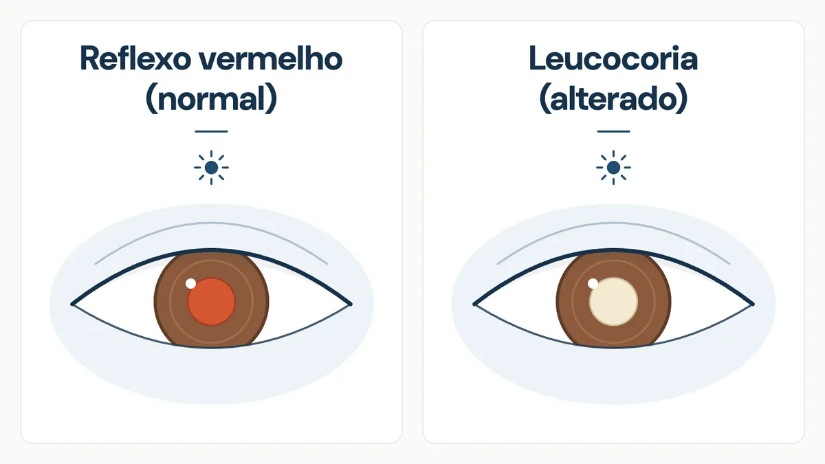 Esquema de dois olhos de íris marrom: reflexo pupilar vermelho à esquerda e branco à direita.