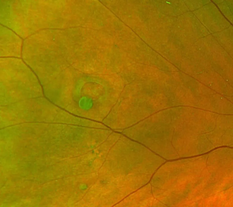 Fotografia do fundo de olho com um pequeno buraco circular na retina e uma pequena tampa de tecido solta ao lado.