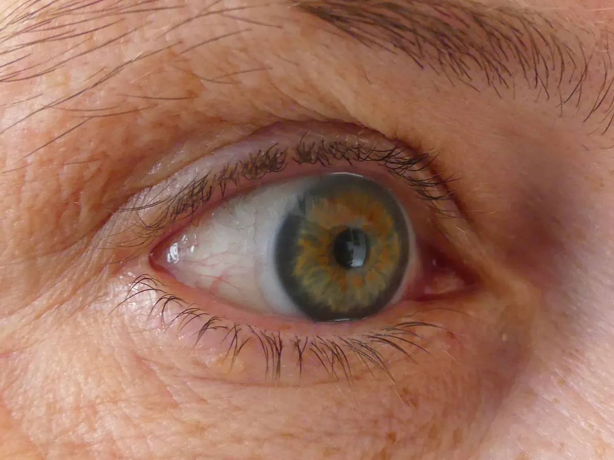 Close de um olho com uma lente de contato sobre a íris.