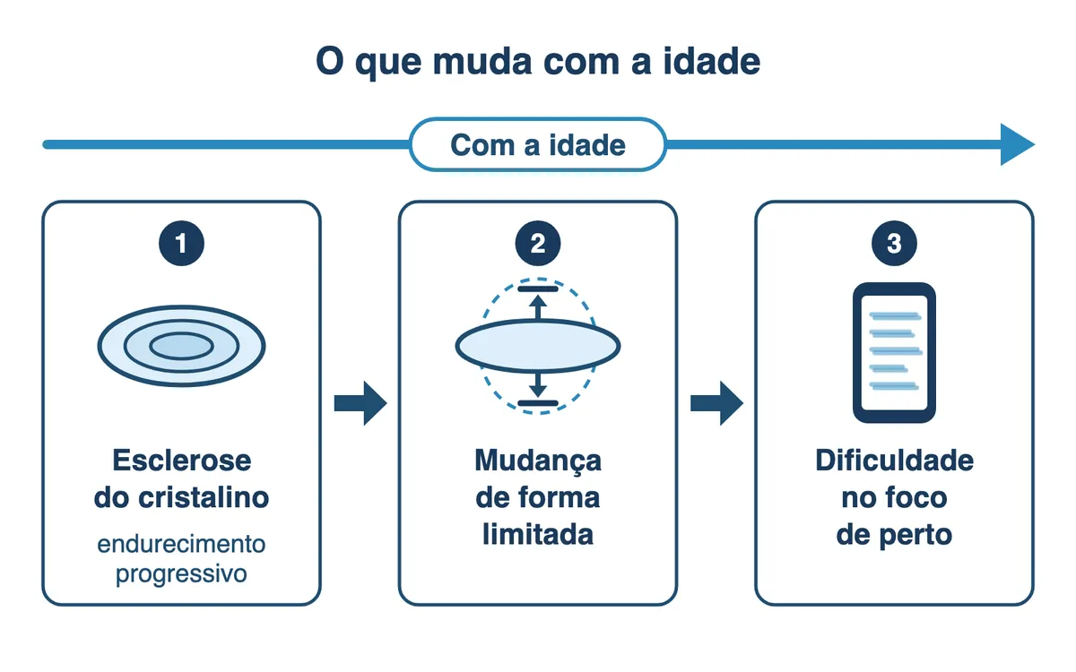 Fluxograma conceitual sob uma seta que indica a passagem da idade: esclerose do cristalino, com endurecimento progressivo, leva a mudança de forma limitada, que leva a dificuldade no foco de perto.