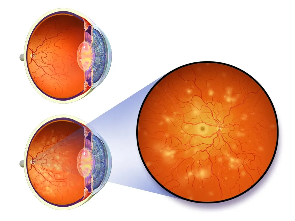 Ilustração de dois olhos, com um círculo ampliado mostrando a retina com pequenos pontos claros e manchas espalhados.