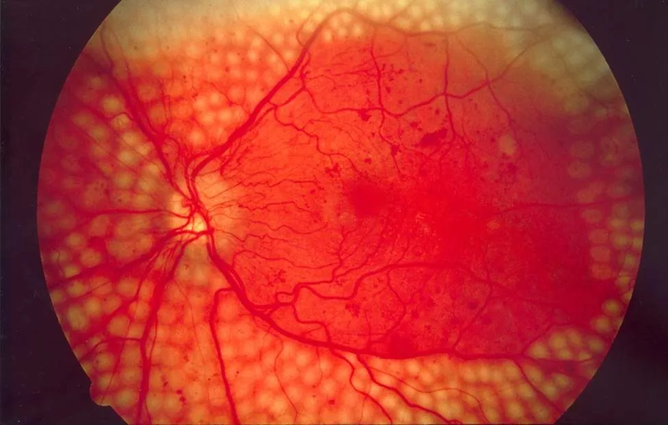 Fotografia do fundo de olho com marcas redondas e claras espalhadas pela retina.