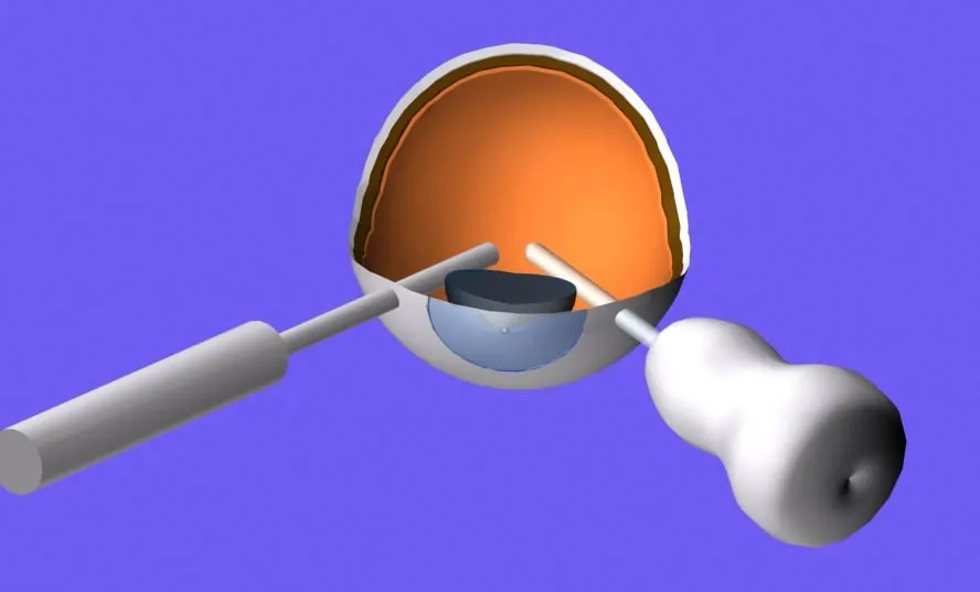 Modelo em 3D de um olho cortado ao meio, com dois instrumentos finos entrando pela parede do olho para trabalhar no interior.