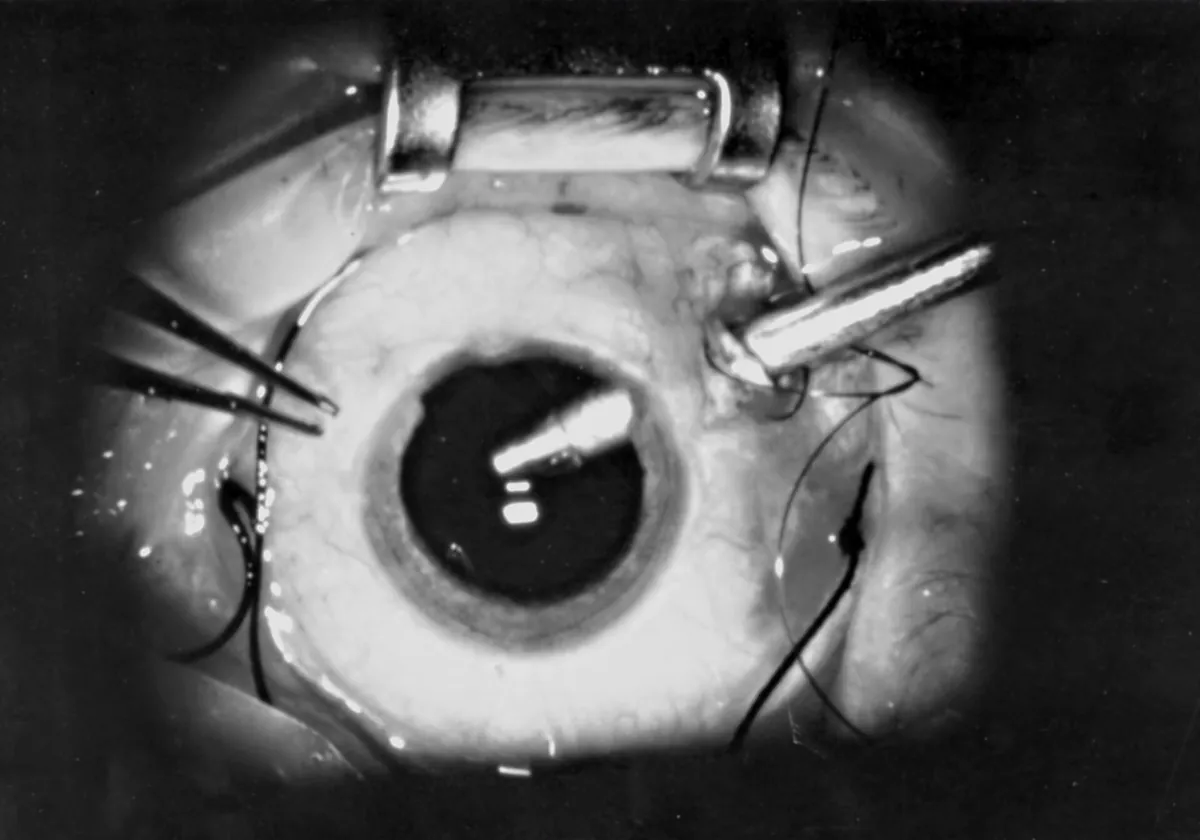 Fotografia em preto e branco de um olho durante a vitrectomia, vista pelo microscópio cirúrgico, com instrumentos finos entrando no olho.