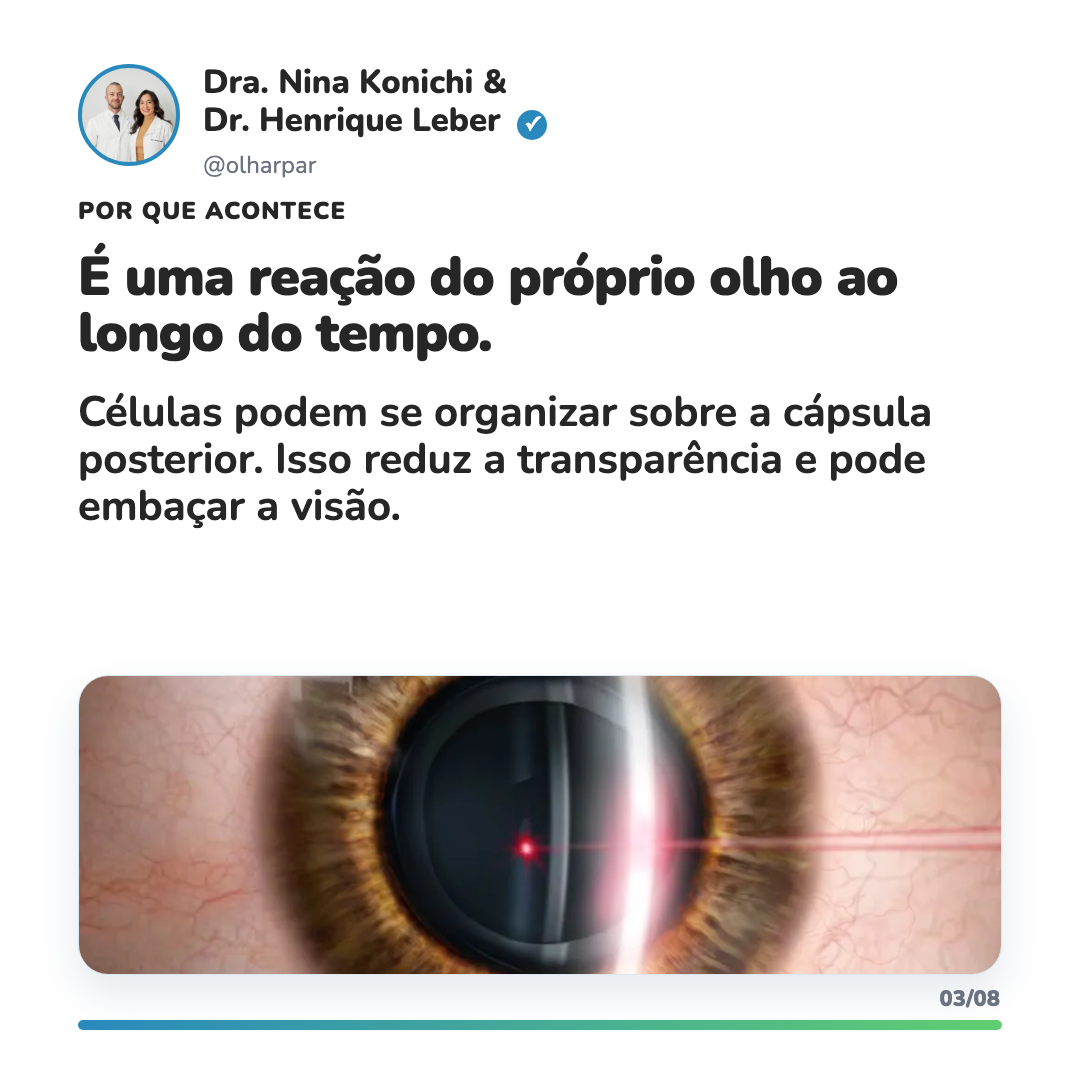 Ilustração de capsulotomia com YAG laser após cirurgia de catarata
